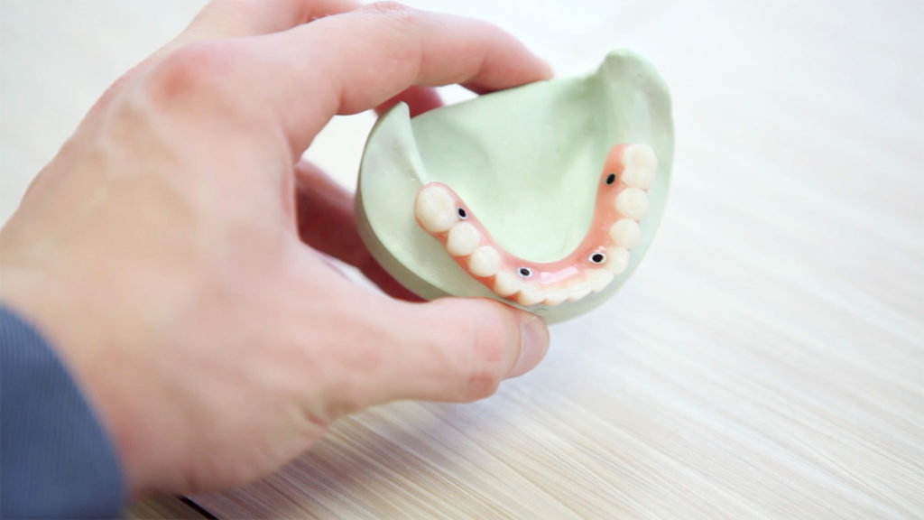 Cuatro implantes dentales para soportar un puente dental