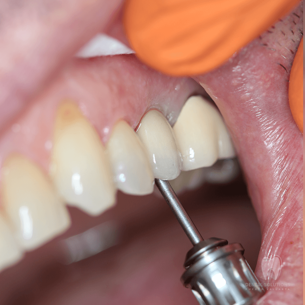 Unitary dental implant