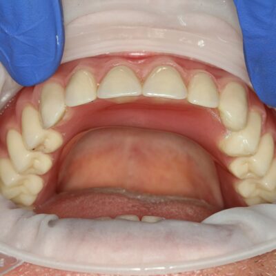 Dental Implants (after)