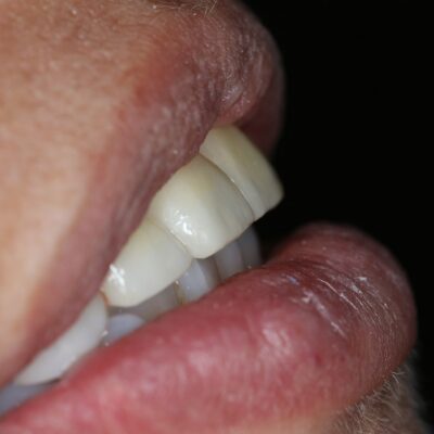 Dental Veneers (after)