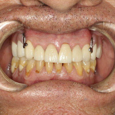 Restauraciones dentales