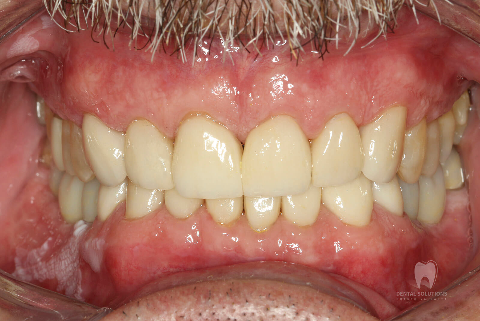 Tratamiento dental restaurativo: otra oportunidad a tus dientes